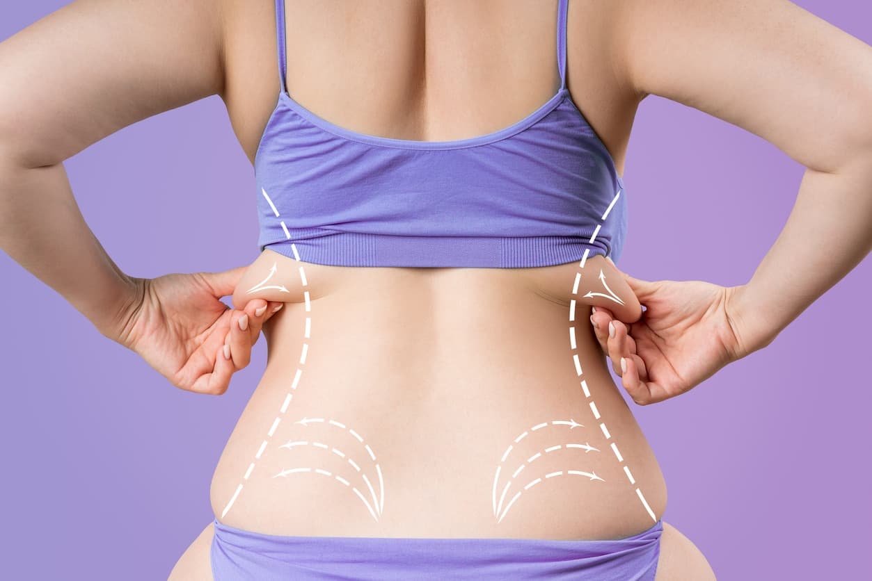 VASER Liposuction in London: Targeting Stubborn Fat, Flanks, and Abdomen